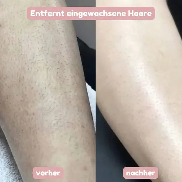 Before-and-after comparison of a leg, with visible hairs and ingrown spots on the left and smooth skin on the right.