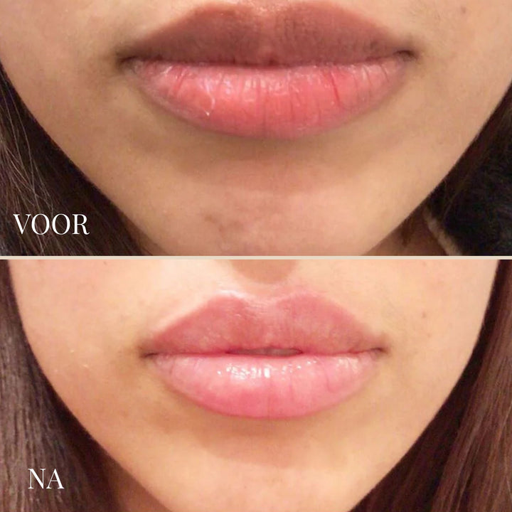 Before and after comparison of lips, with the lower photo showing fuller, glossier pink lips.