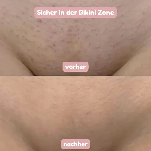 Before-and-after close-up of the bikini area, showing stubble and dark dots on top and smoother skin below.