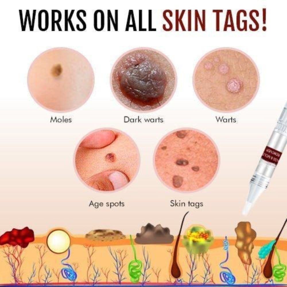 Detail infographic showing moles, warts, age spots and skin tags with a skin cross-section and pen.