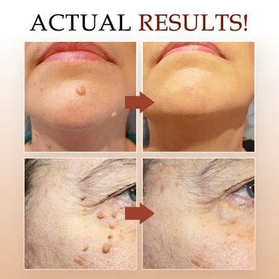 Another view showing before-and-after face areas with skin tags and small growths cleared.