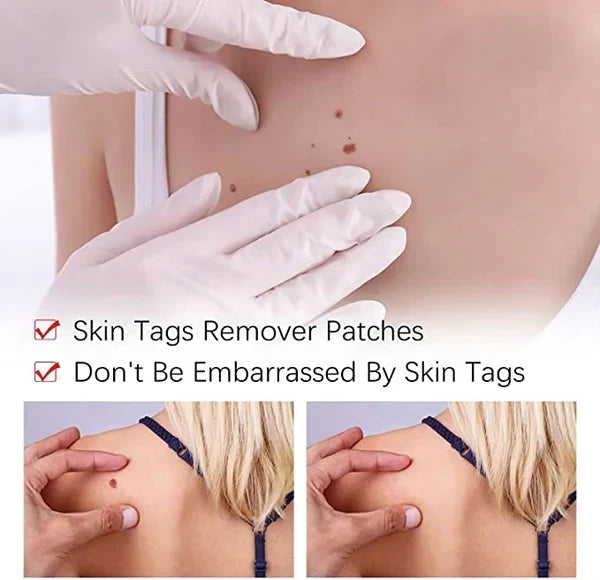 Another view showing gloved hands examining a back with small moles and shoulder before-and-after close-ups.