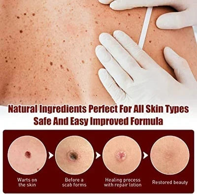Another view showing gloved hands on a freckled back above four stages of a wart healing.