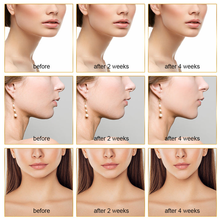 EMS FACE LIFT WITH LED THERAPY - SLIMMER FACE AND DOUBLE CHIN REMOVAL-White-Nora Luxe