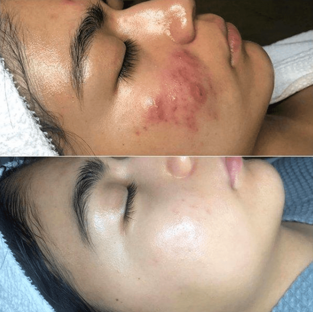 Skin therapy with High Frequency - GlowWave-Nora Luxe